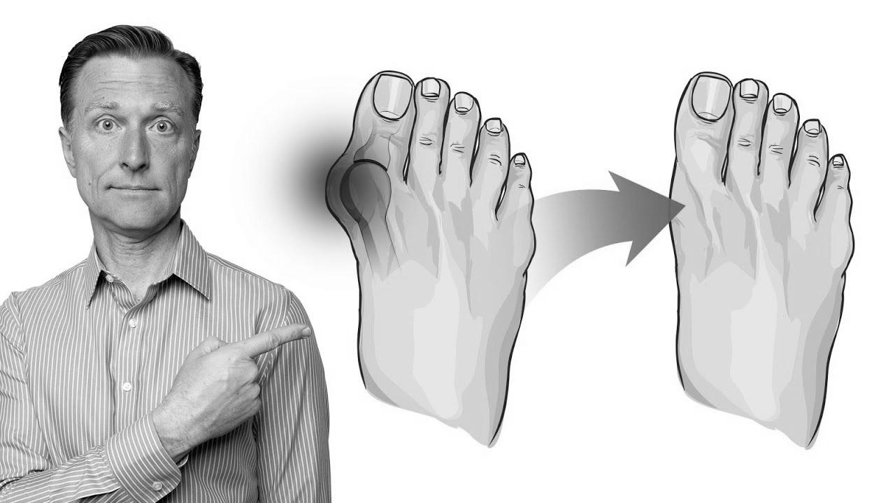 The best way to Repair Bunions in 3 Steps