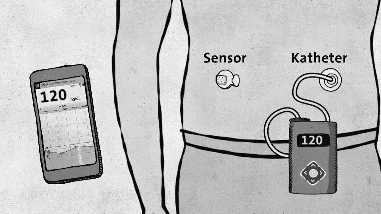 Sort 1 diabetes – modern technology without approval – good to know